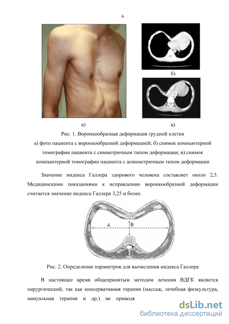 Деформация грудной клетки у детей